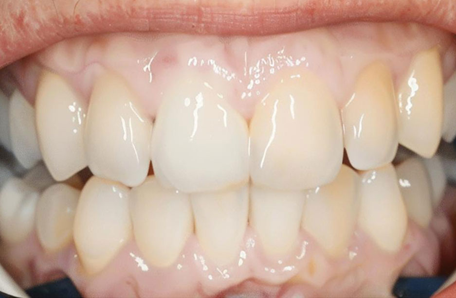 teeth-3-a